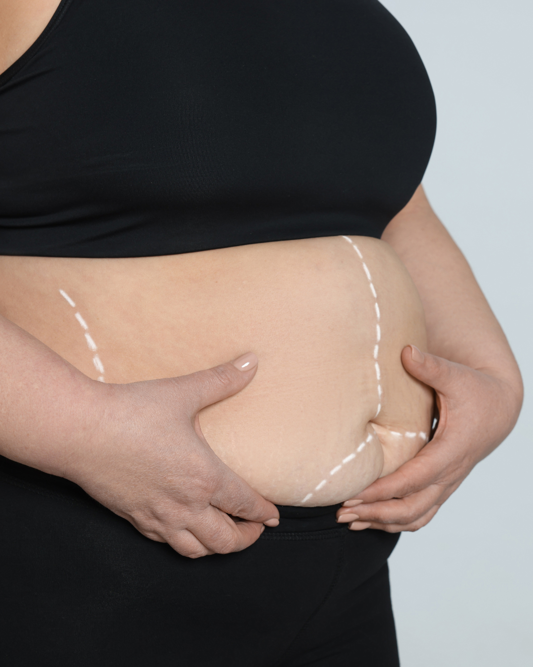 La chirurgie bariatrique (Sleeve, Bypass, etc.)